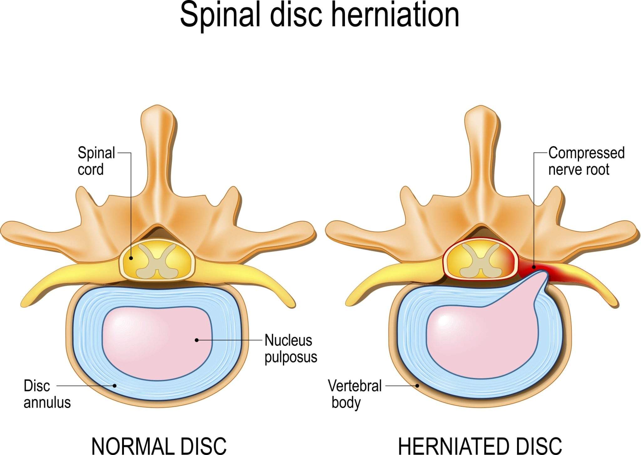 spinal disc