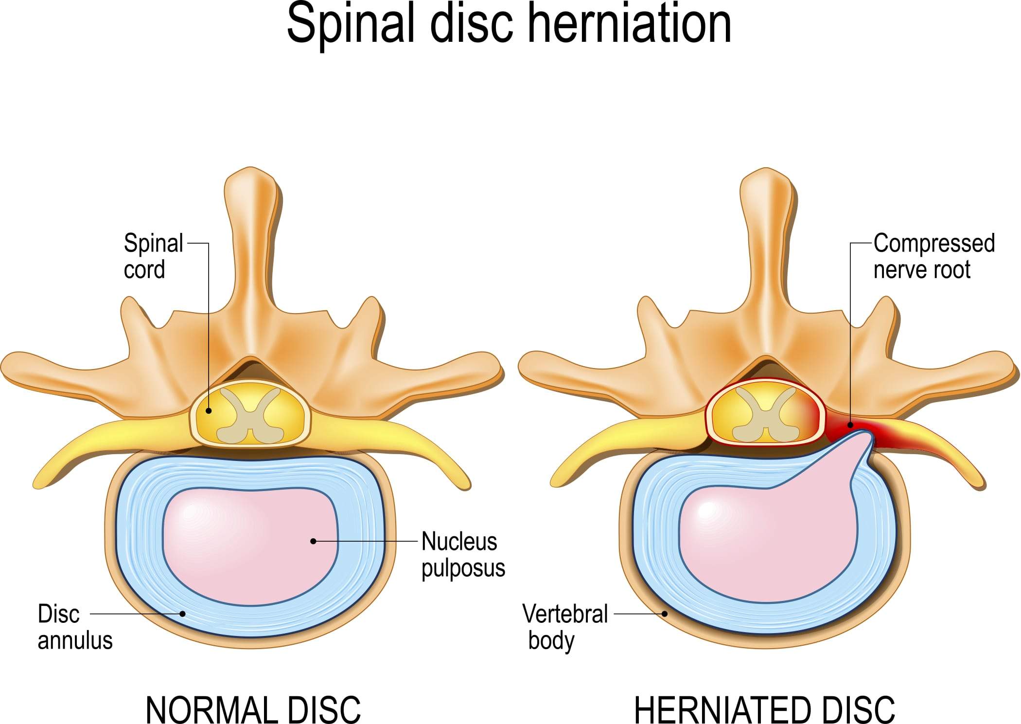 Spine Condition - Herniated Disc