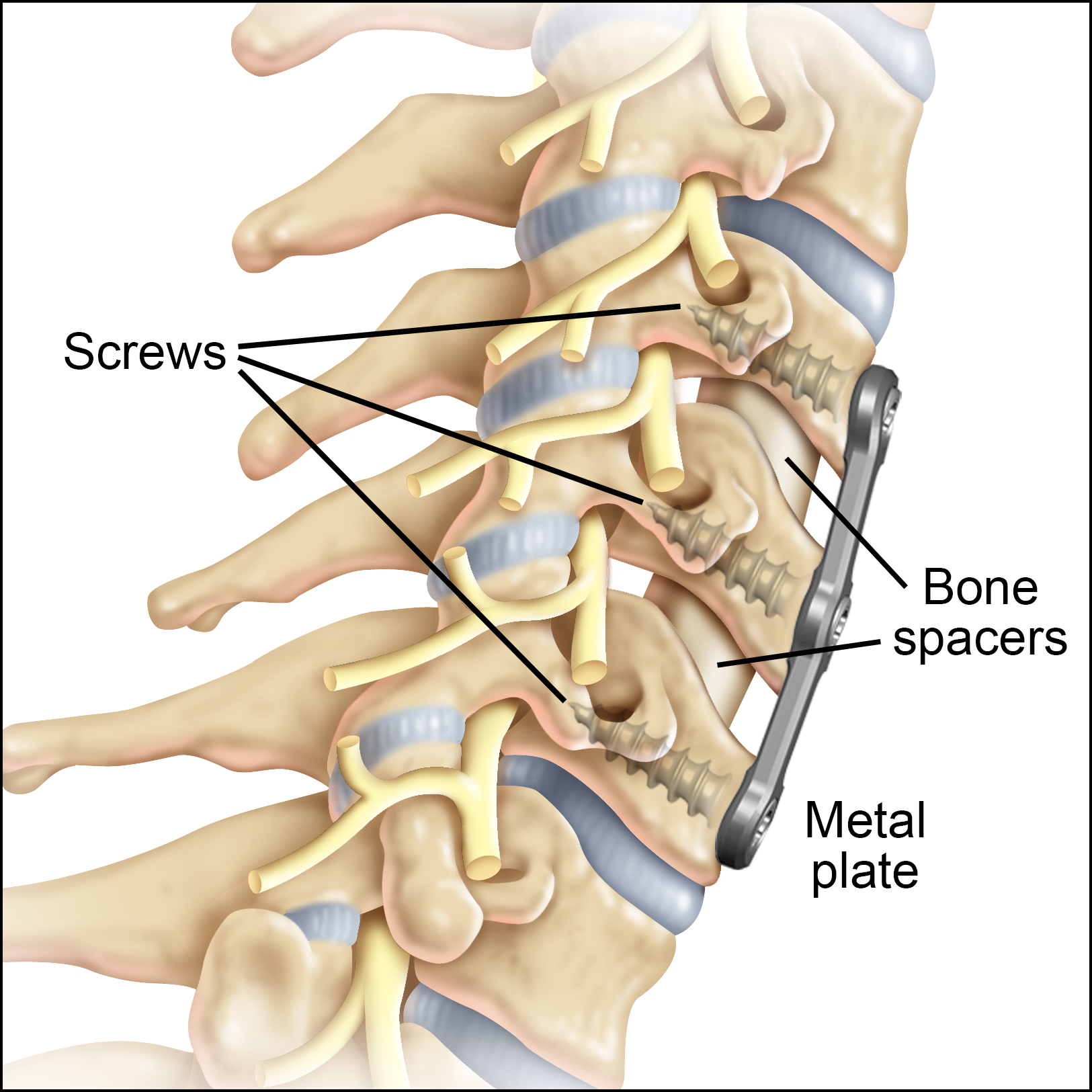 Cervical Spine Fusion C3-C5 ACDF