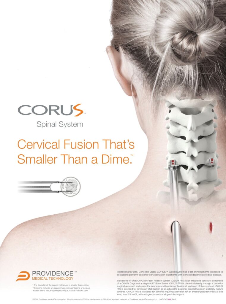 Minimally Invasive Posterior Cervical Fusion Spine Surgeon Antonio