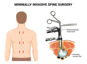 Minimally Invasive Tubular Retraction Mitr Spine Surgeon Antonio